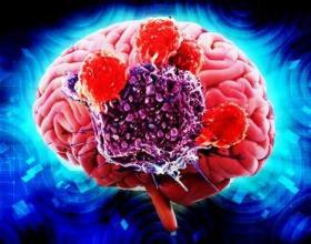 Image result for Artificial Intelligence Reveals Mechanism Behind Brain Tumor
